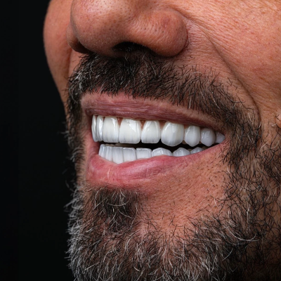 Hollywood Smile (8 Upper Teeth)