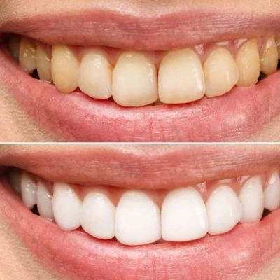 Cleaning and Whitening