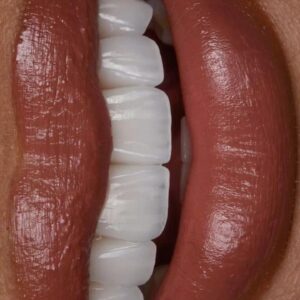 Hollywood Smile