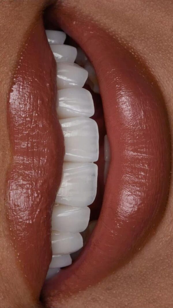 Hollywood Smile