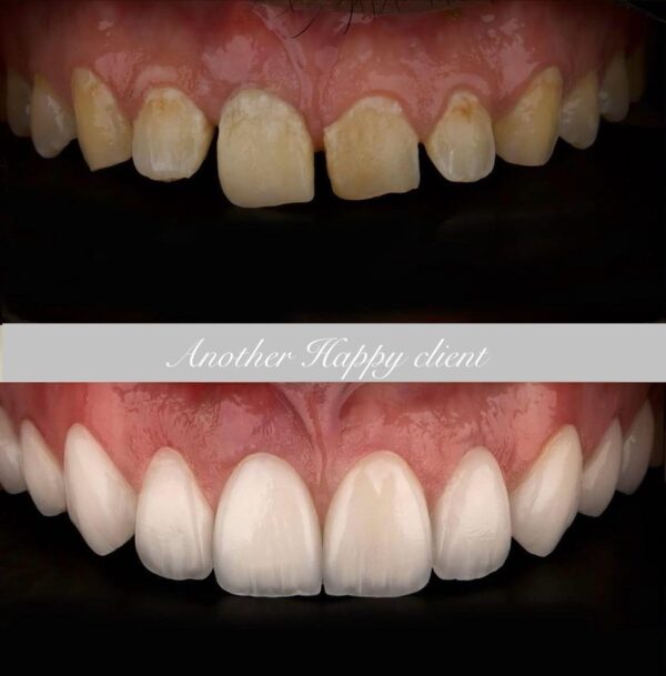 Hollywood Smile - Image 2