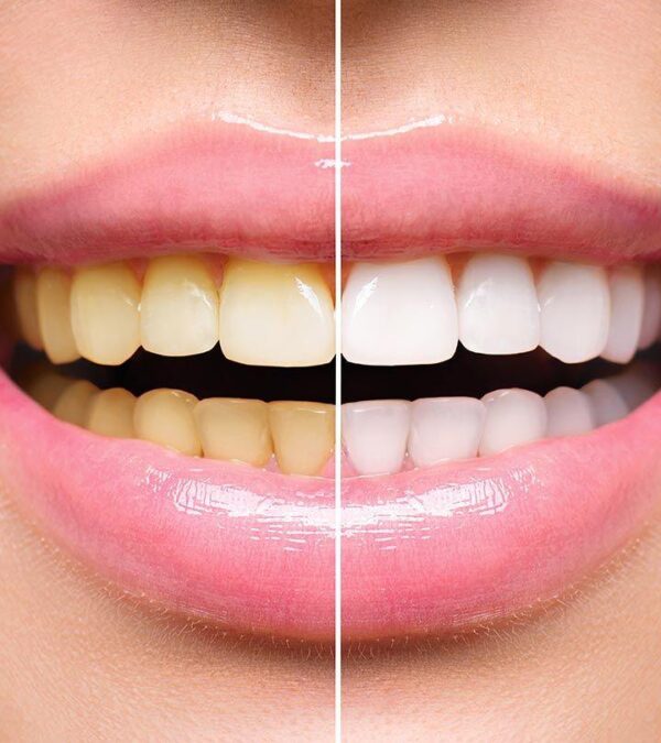 Cleaning and Whitening - Image 4