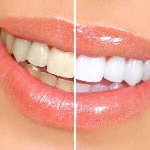 Cleaning and Whitening