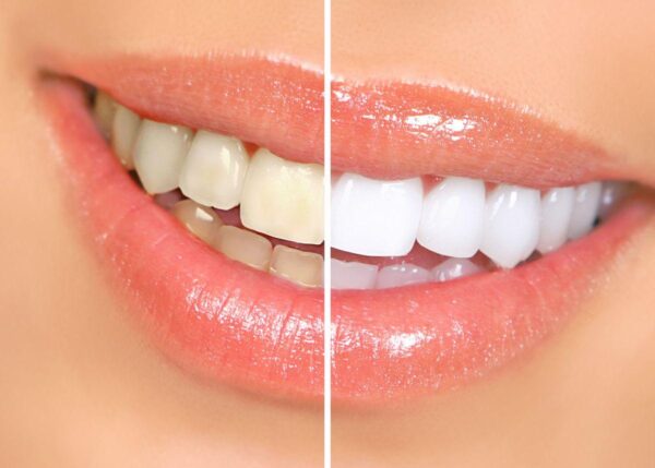 Cleaning and Whitening