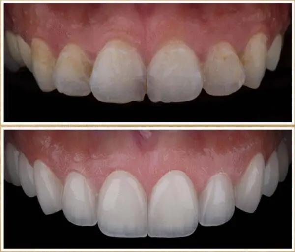Hollywood Smile - Image 4