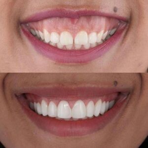 Gummy Smile Correction