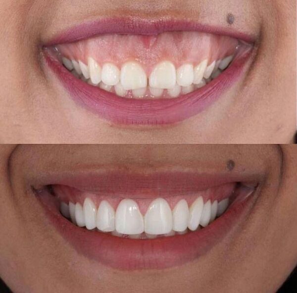 Gummy Smile Correction