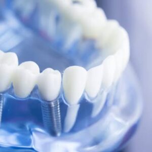 Implant with Crown