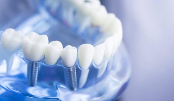 Implant with Crown