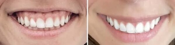 Gummy Smile Correction - Image 2