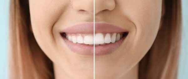 Gummy Smile Correction - Image 3