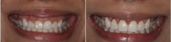 Gummy Smile Correction - Image 4