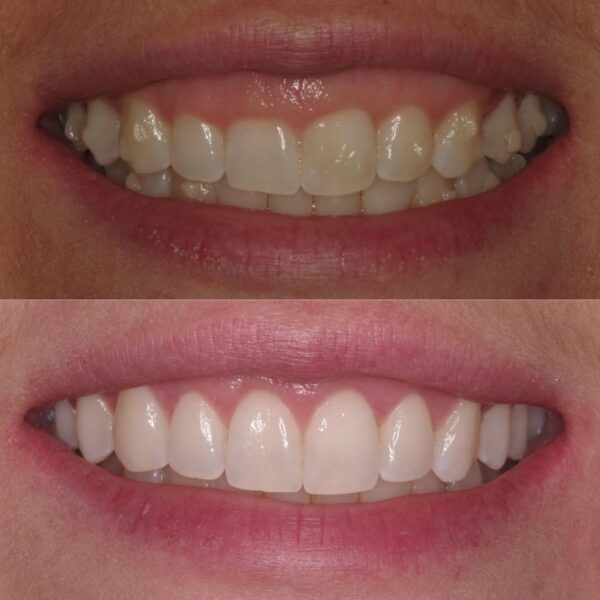 Gummy Smile Correction - Image 5