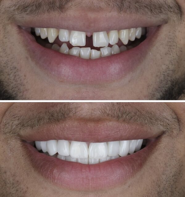 Hollywood Smile - Image 7