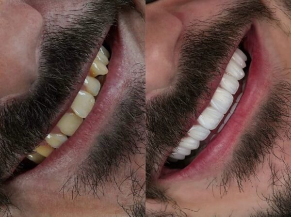 Hollywood Smile - Image 5