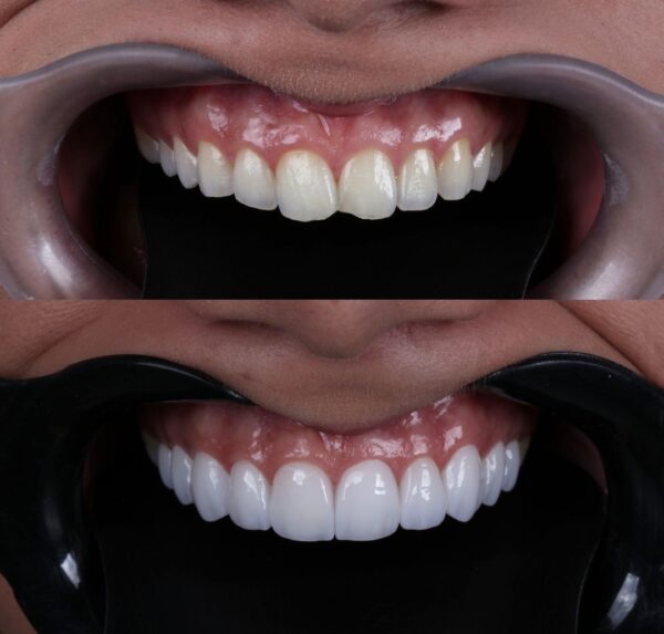 Hollywood Smile - Image 8