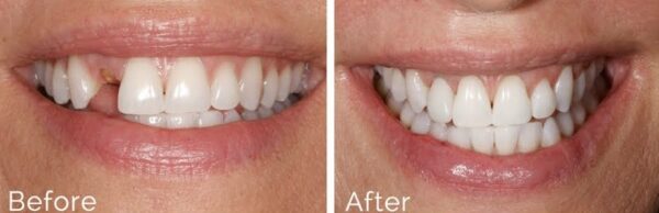 Implant with Crown - Image 2