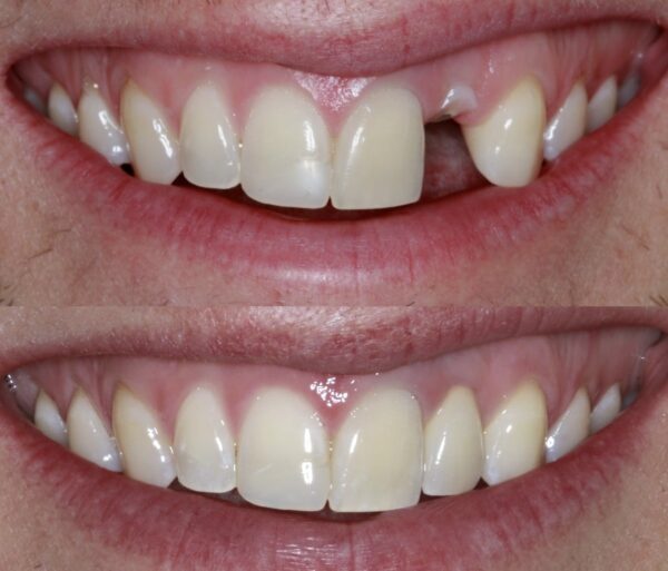 Implant with Crown - Image 3