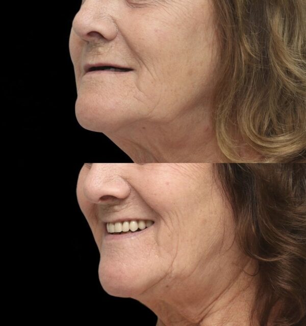 Implant with Crown - Image 4