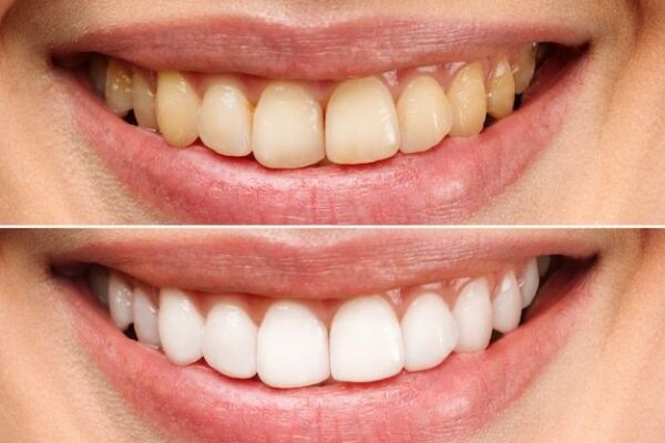 Cleaning and Whitening - Image 7