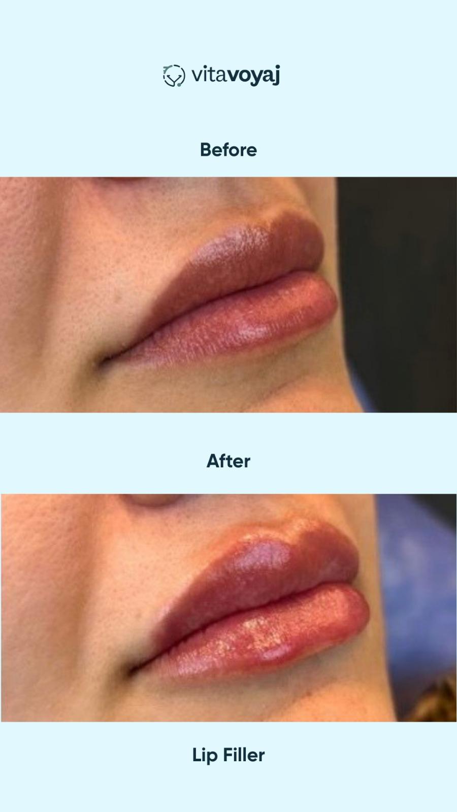 Fillers - Image 19