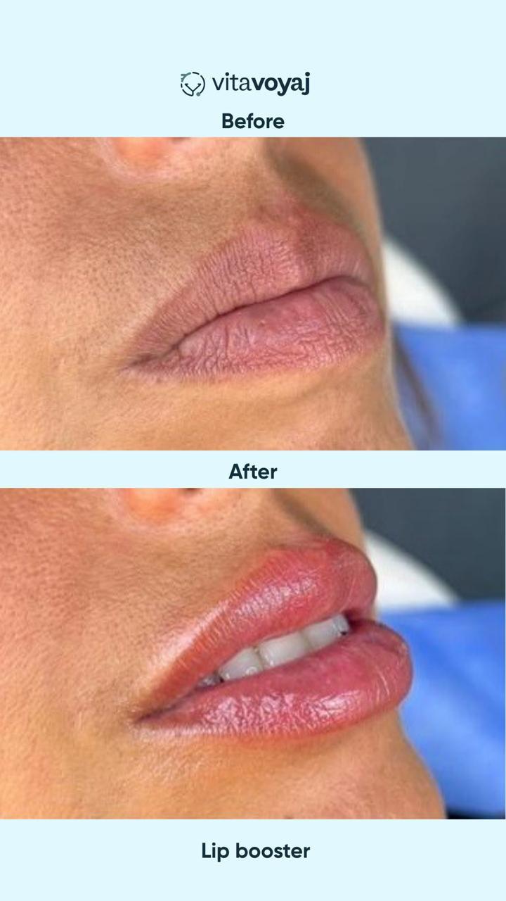 Skin boosters - Image 2