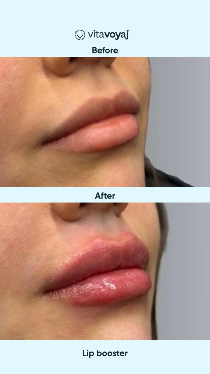 Skin boosters - Image 5