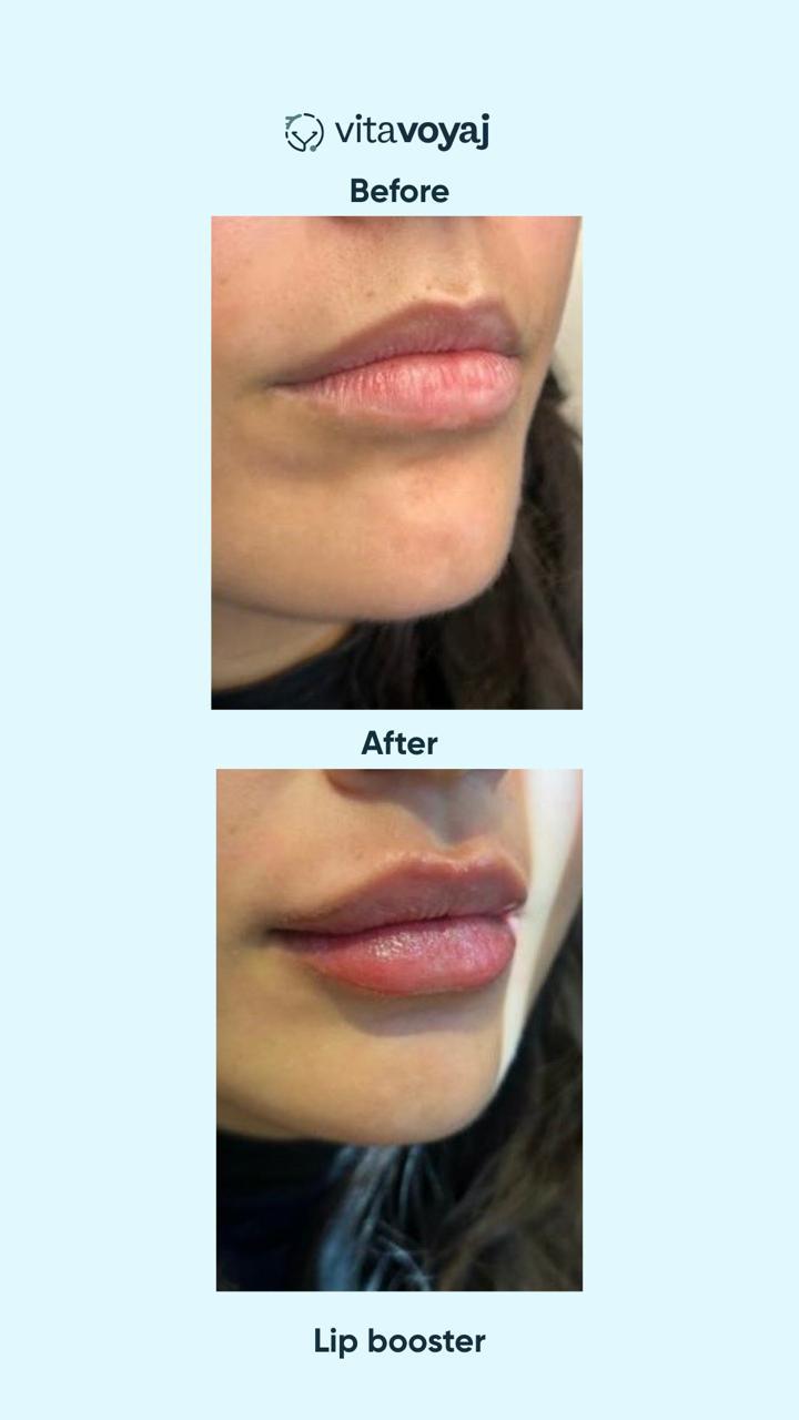 Skin boosters - Image 6