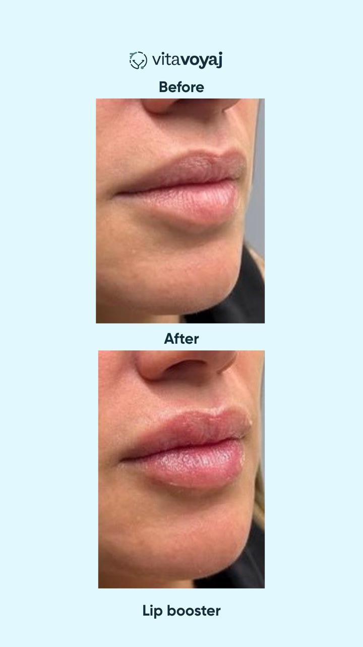 Skin boosters - Image 7