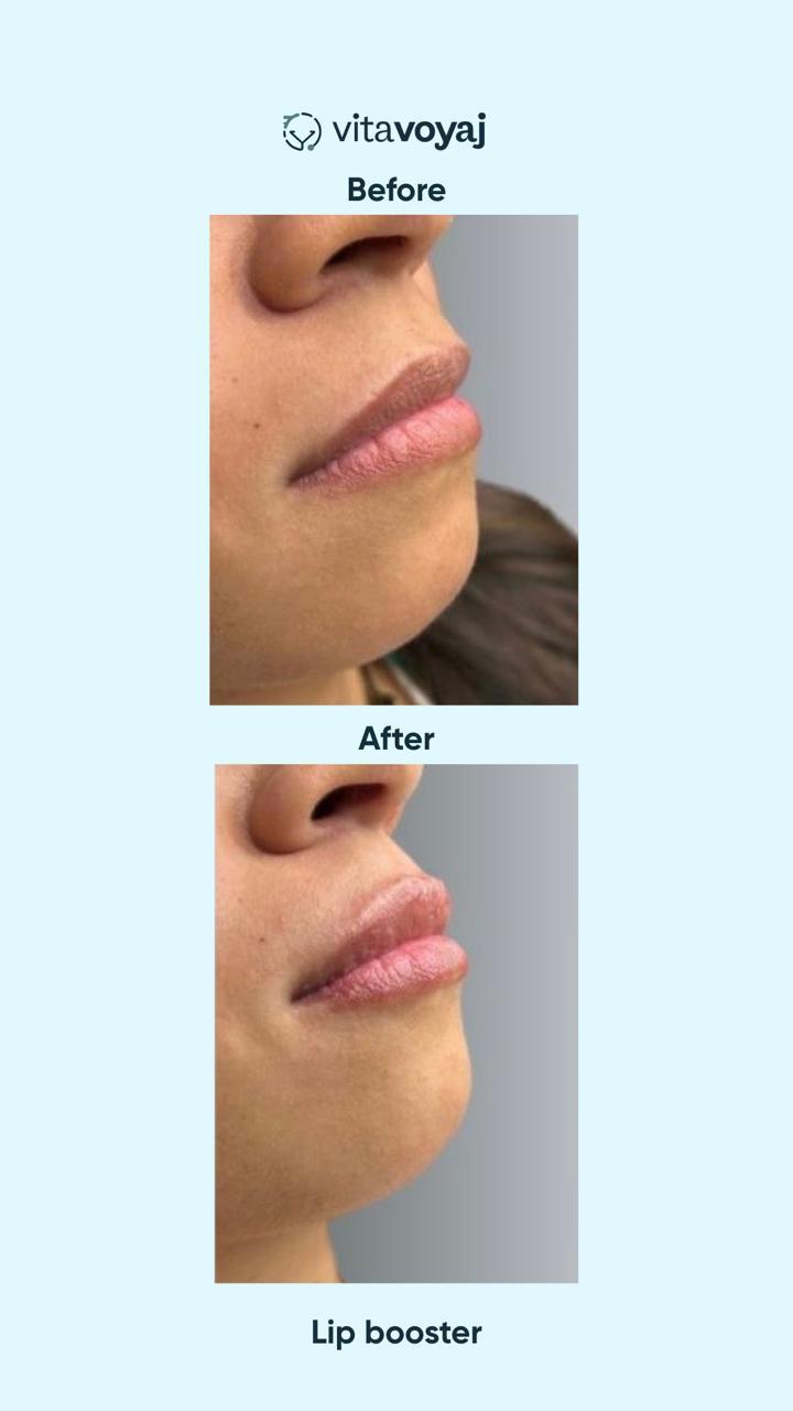 Skin boosters - Image 8