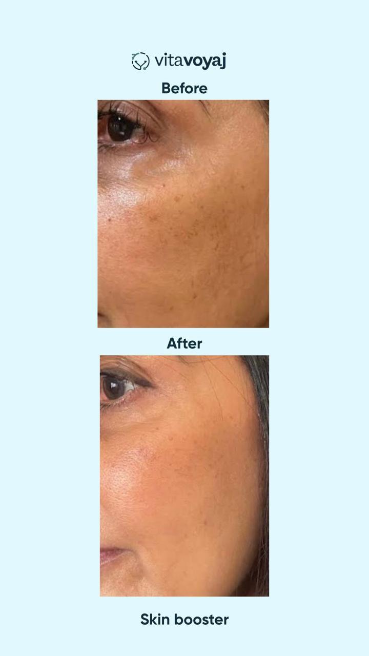 Skin boosters - Image 9