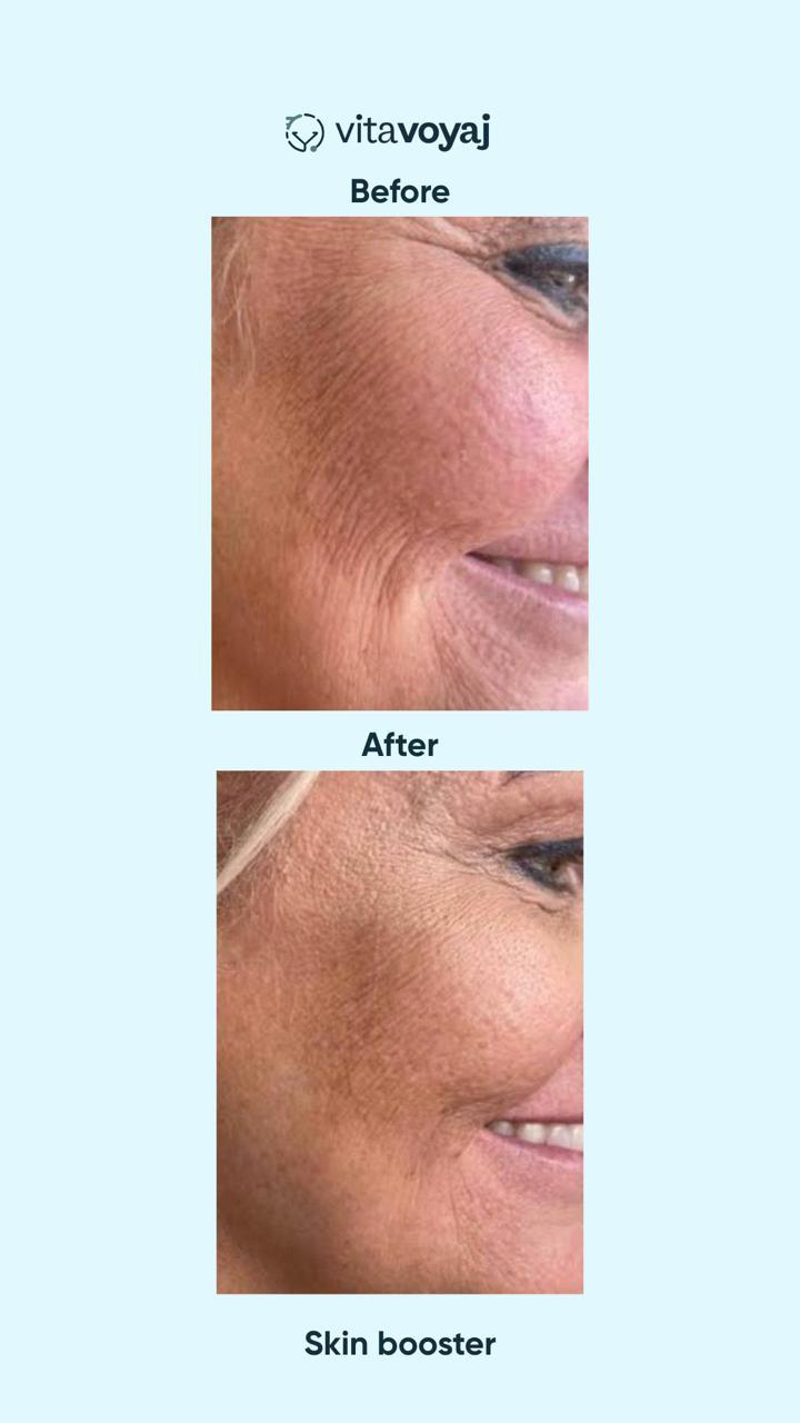 Skin boosters - Image 10