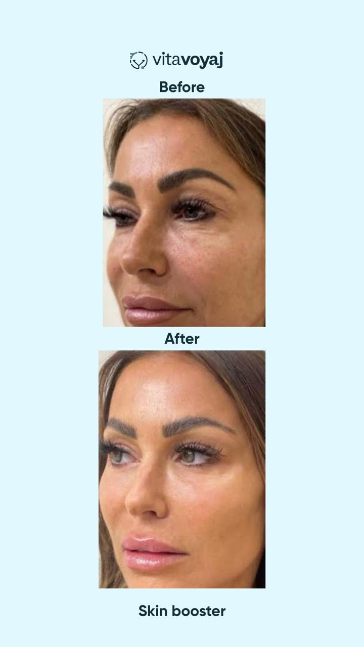 Skin boosters - Image 11