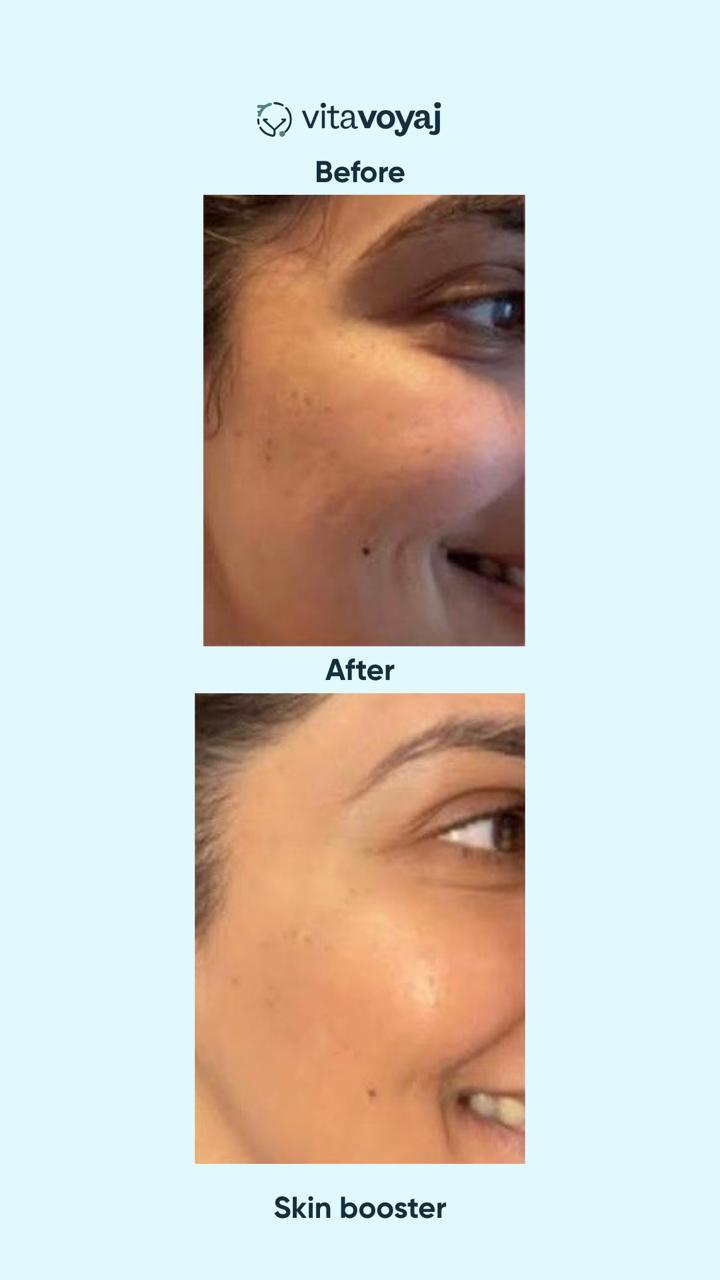 Skin boosters - Image 12