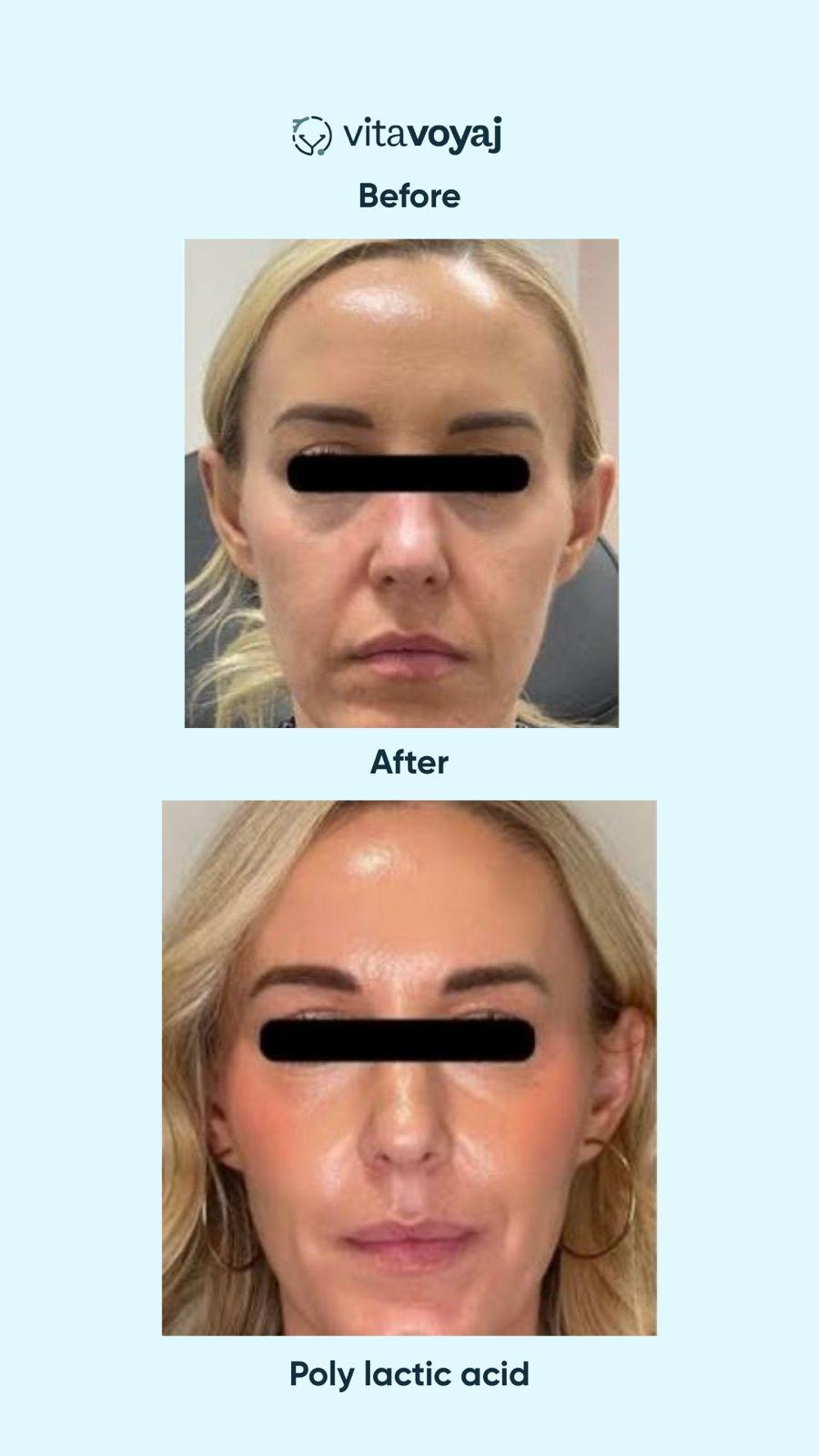 Skin boosters - Image 13