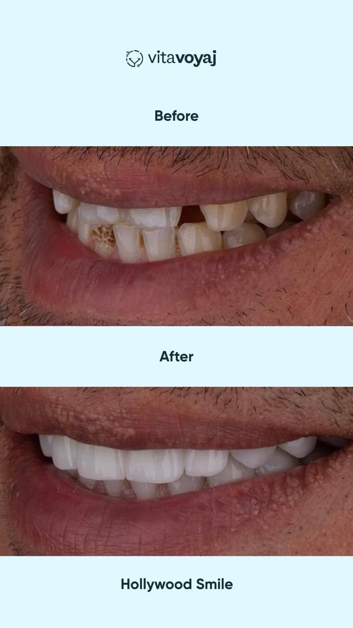 Hollywood Smile (8 Upper Teeth) - Image 3