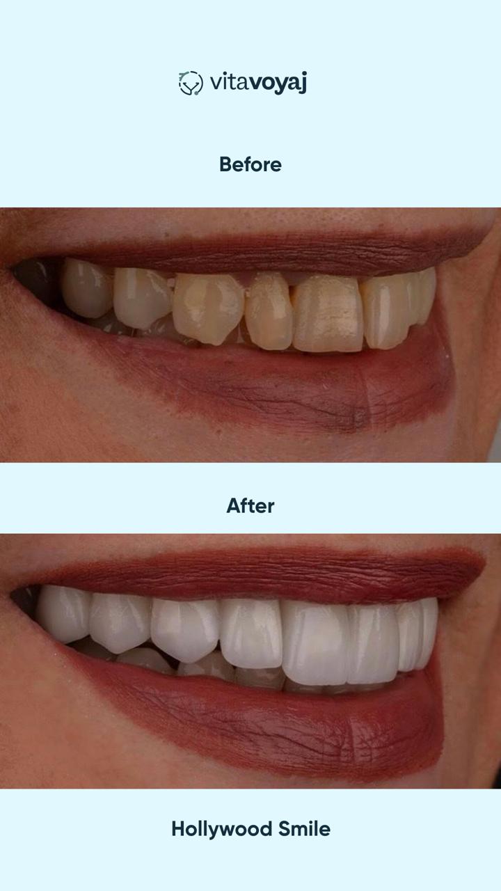 Hollywood Smile (8 Upper Teeth) - Image 17