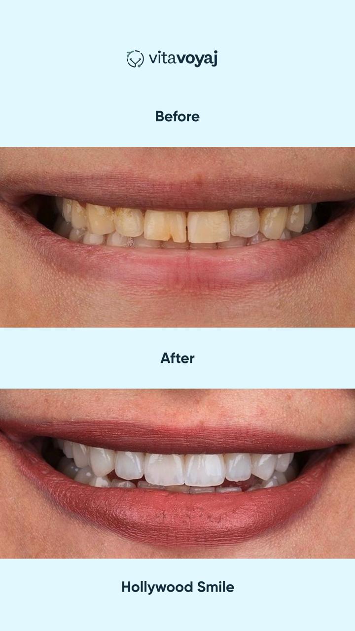 Hollywood Smile (8 Upper Teeth) - Image 4
