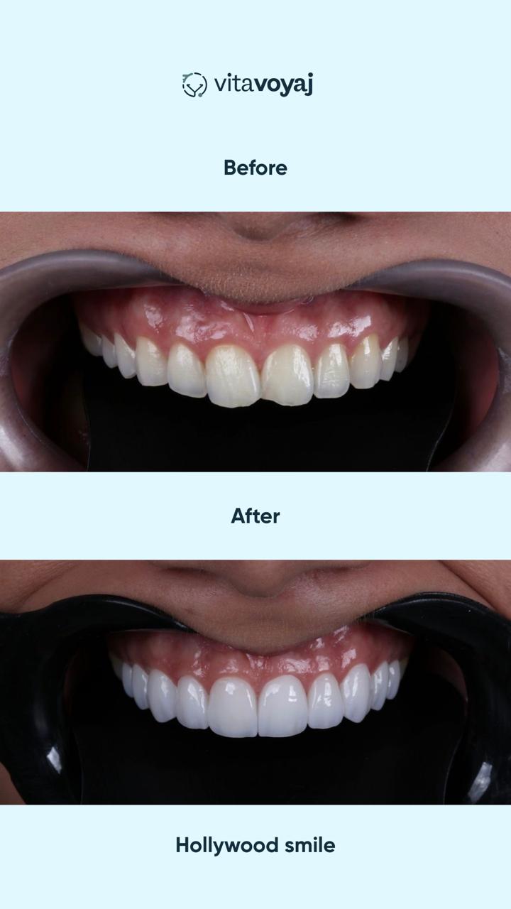 Hollywood Smile (8 Upper Teeth) - Image 6