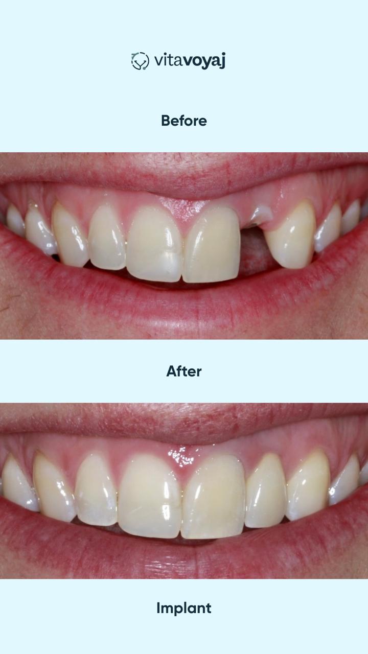 Implant with Crown - Image 4