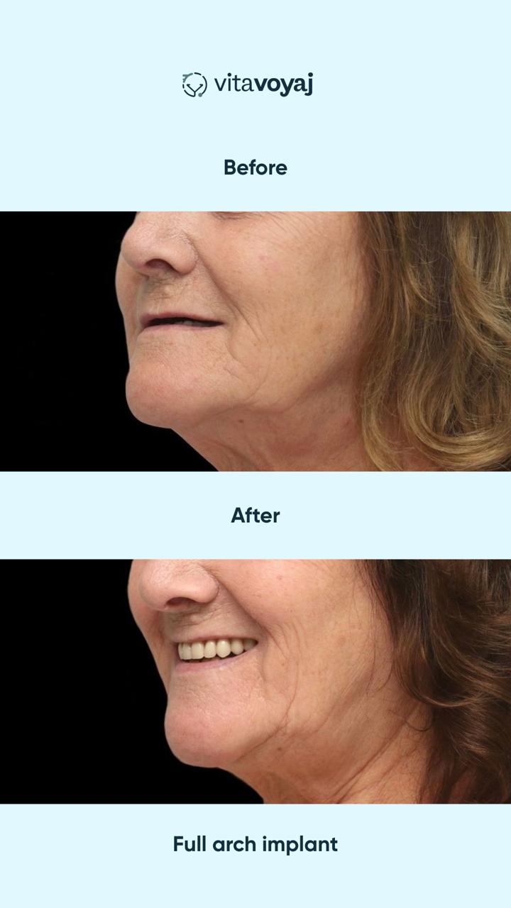 Implant with Crown - Image 3