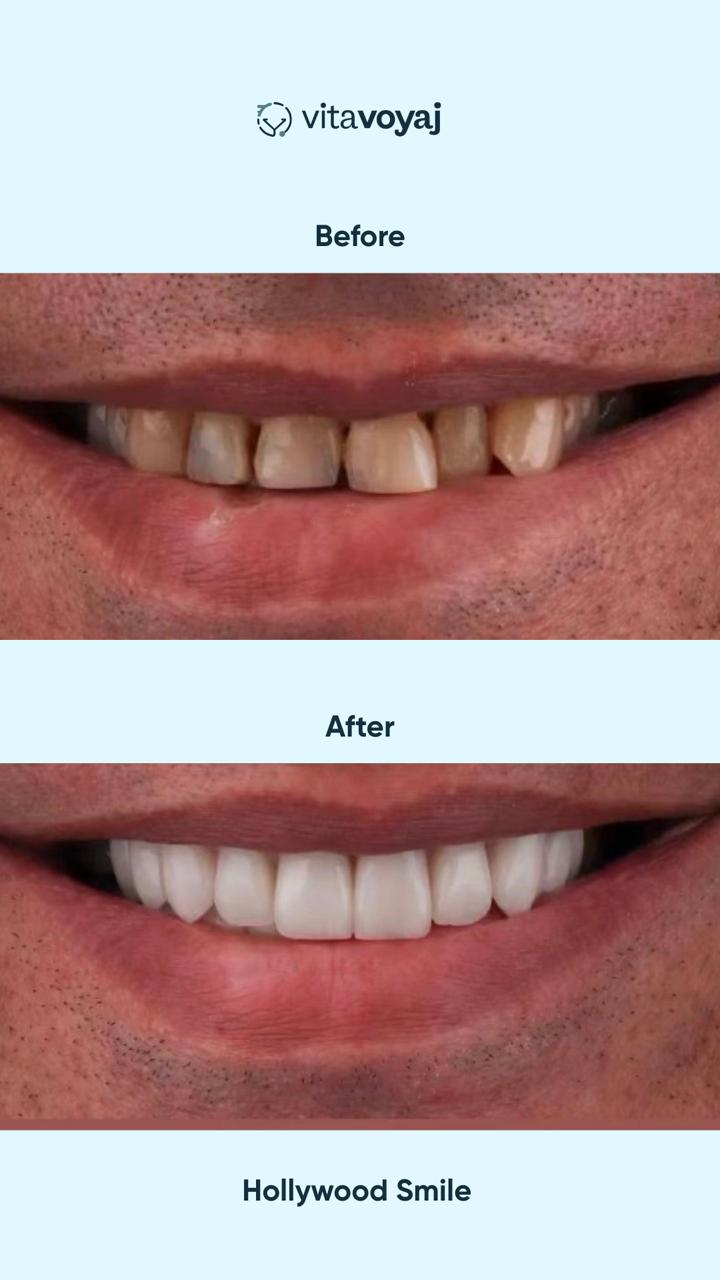 Hollywood Smile (8 Upper Teeth) - Image 9