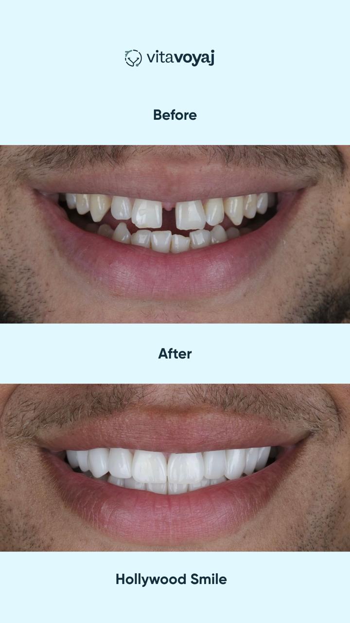 Hollywood Smile (8 Upper Teeth) - Image 7