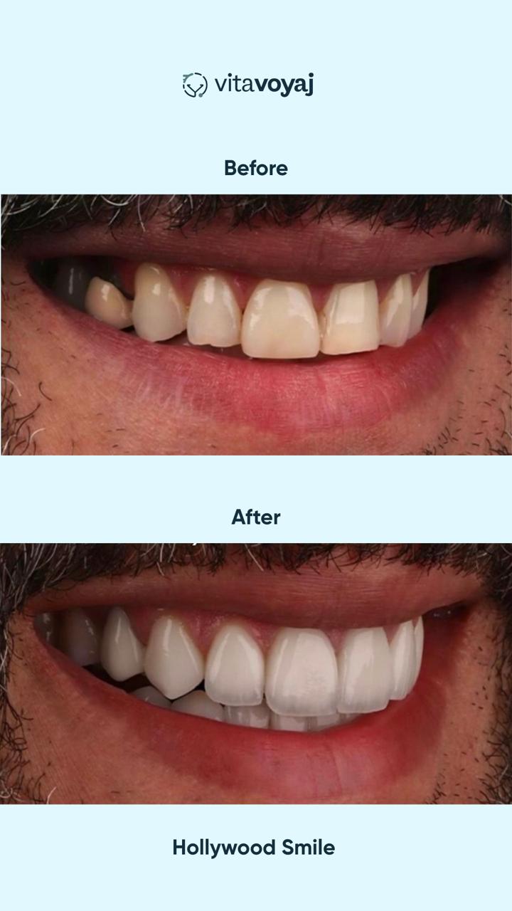 Hollywood Smile (8 Upper Teeth) - Image 8