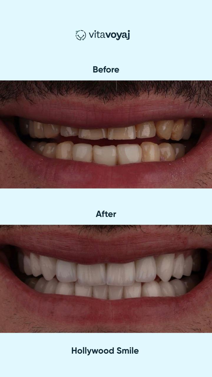 Hollywood Smile (8 Upper Teeth) - Image 10
