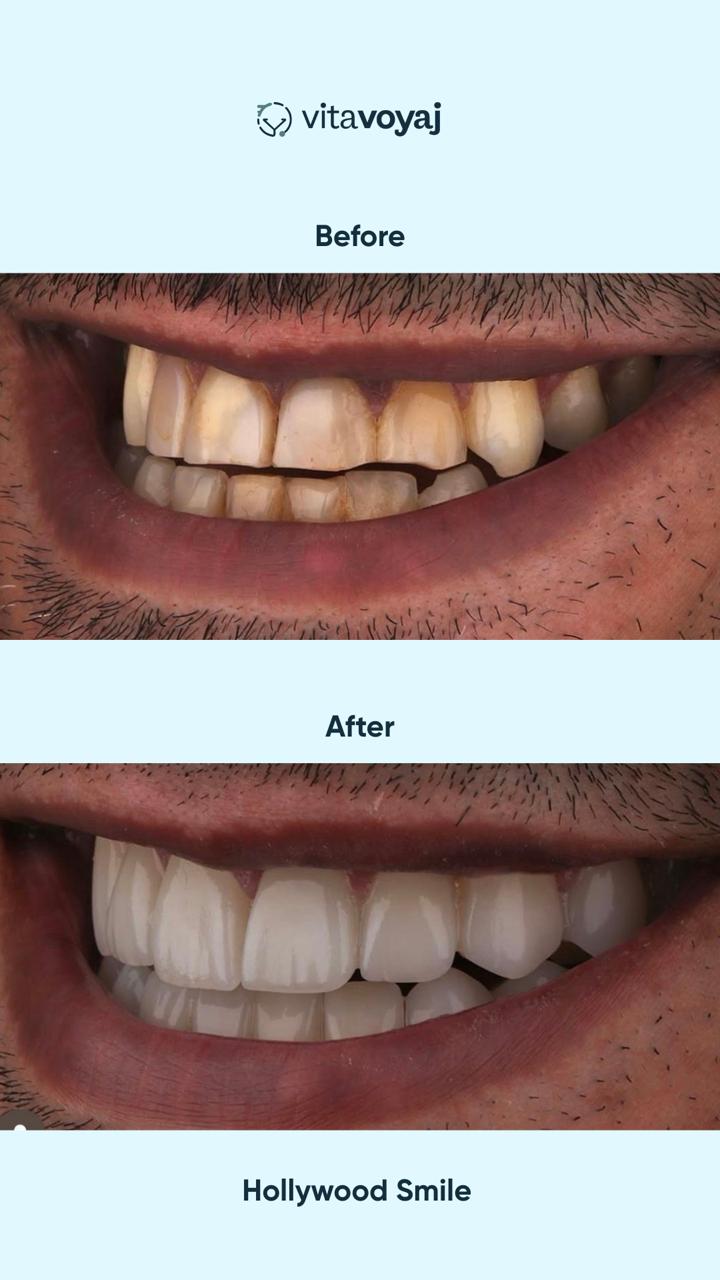 Hollywood Smile (8 Upper Teeth) - Image 11