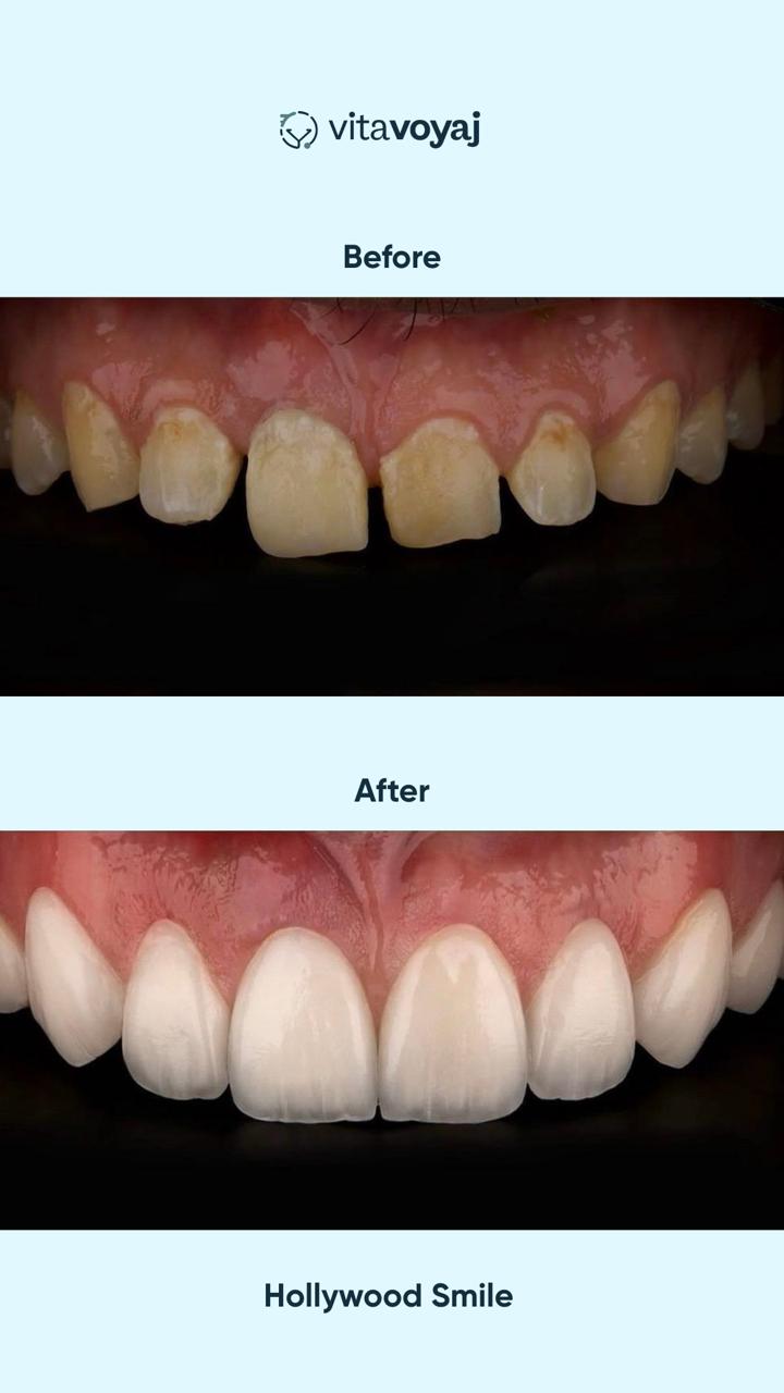 Hollywood Smile (8 Upper Teeth) - Image 13