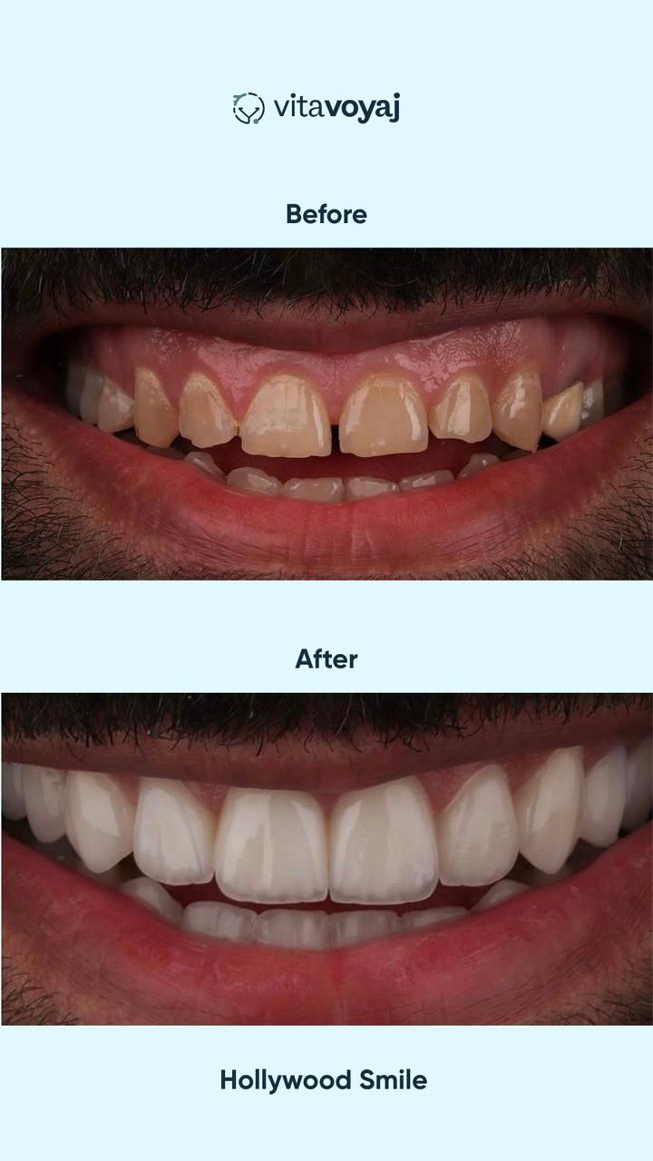 Hollywood Smile (8 Upper Teeth) - Image 14