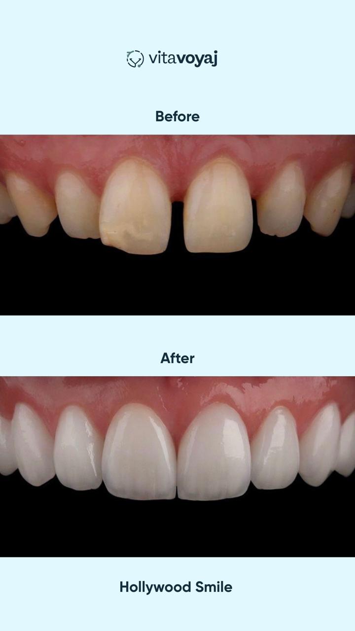 Hollywood Smile (8 Upper Teeth) - Image 15