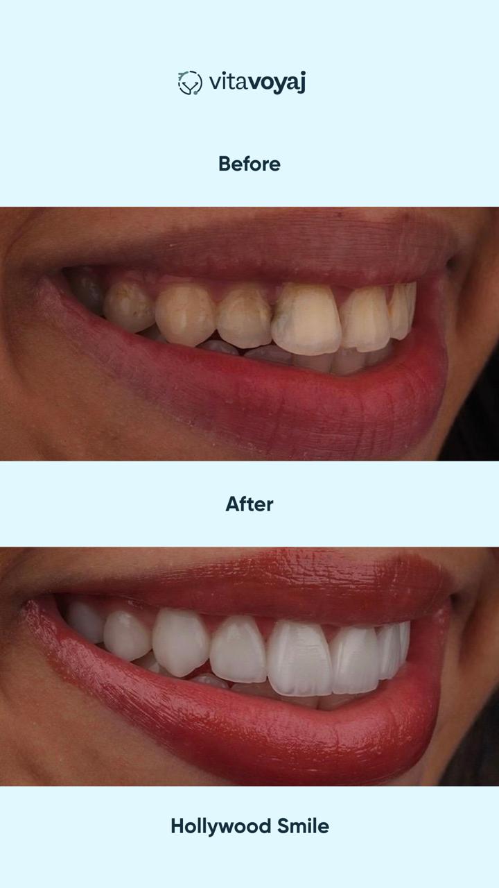 Hollywood Smile (8 Upper Teeth) - Image 2